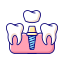 dental implant